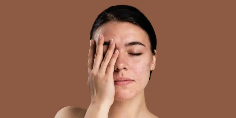 Melazma (Yüzdeki Gizemli Lekeler) Nedir?